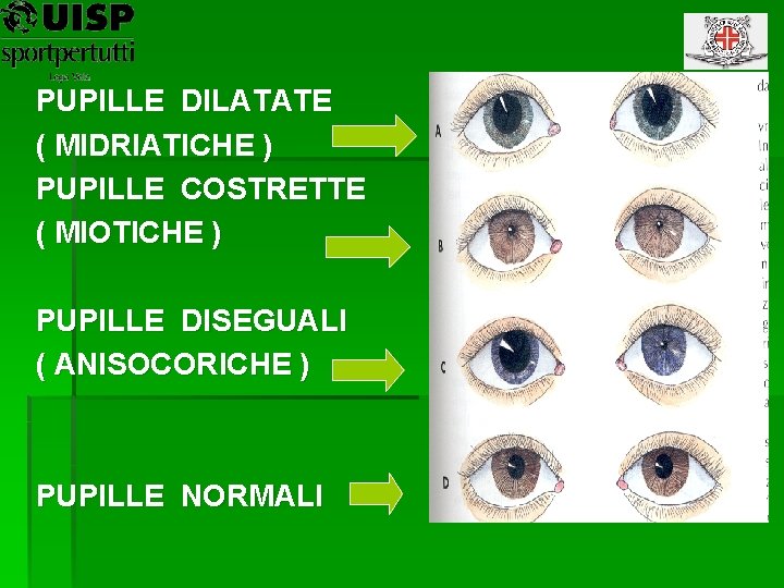 PUPILLE DILATATE ( MIDRIATICHE ) PUPILLE COSTRETTE ( MIOTICHE ) PUPILLE DISEGUALI ( ANISOCORICHE