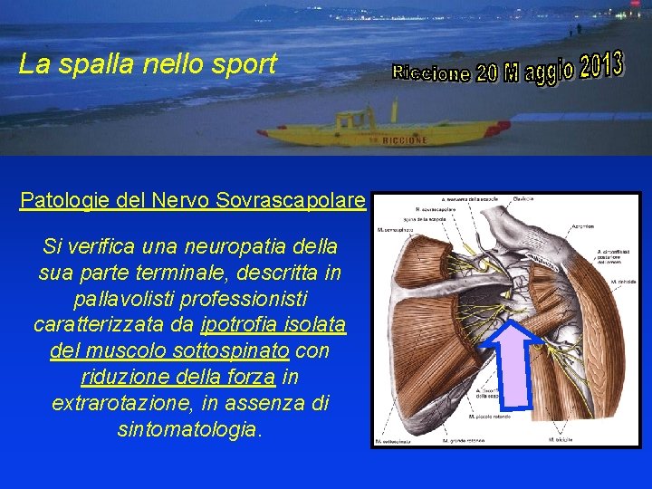 La spalla dello sportivo La spalla nello sport Patologie del Nervo Sovrascapolare Si verifica