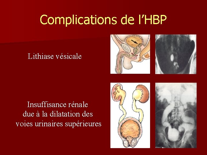 Complications de l’HBP Lithiase vésicale Insuffisance rénale due à la dilatation des voies urinaires