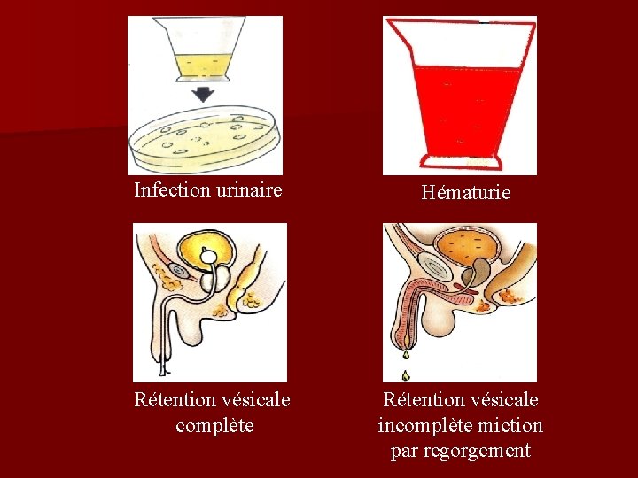 Infection urinaire Hématurie Rétention vésicale complète Rétention vésicale incomplète miction par regorgement 