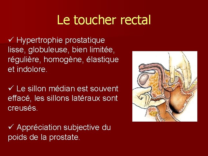 Le toucher rectal ü Hypertrophie prostatique lisse, globuleuse, bien limitée, régulière, homogène, élastique et