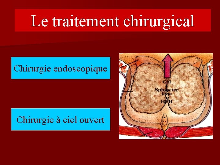 Le traitement chirurgical Chirurgie endoscopique Chirurgie à ciel ouvert 
