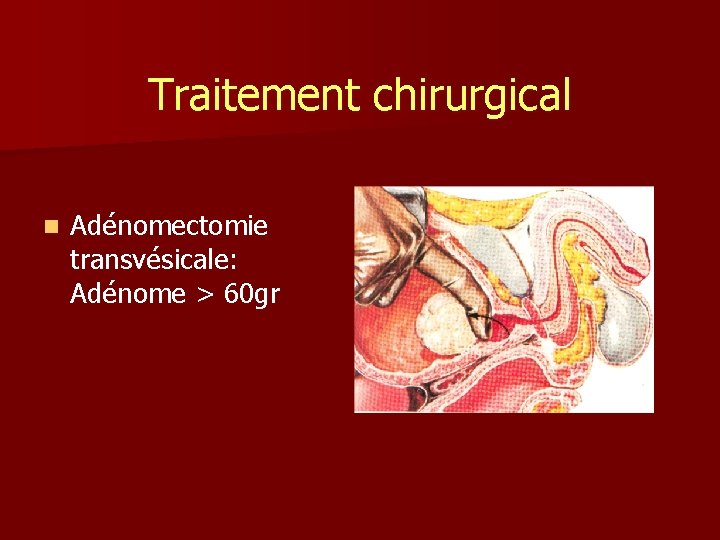 Traitement chirurgical n Adénomectomie transvésicale: Adénome > 60 gr 