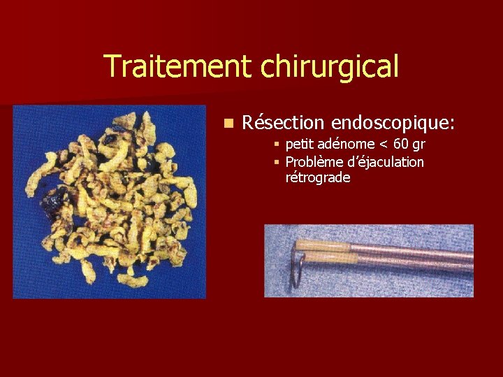 Traitement chirurgical n Résection endoscopique: § petit adénome < 60 gr § Problème d’éjaculation
