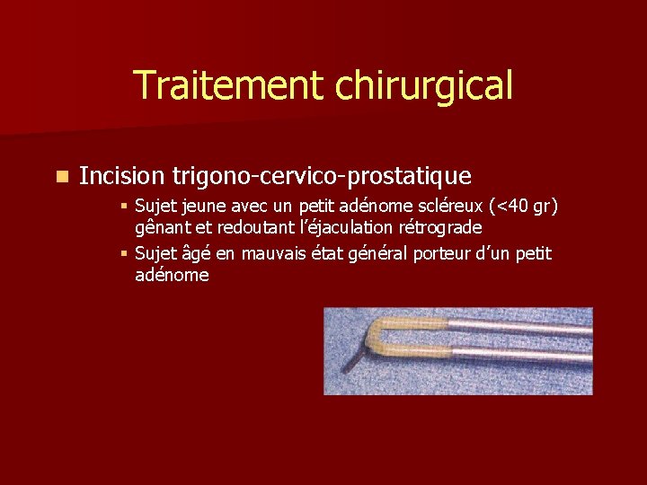 Traitement chirurgical n Incision trigono-cervico-prostatique § Sujet jeune avec un petit adénome scléreux (<40