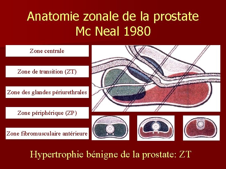 Anatomie zonale de la prostate Mc Neal 1980 Zone centrale Zone de transition (ZT)