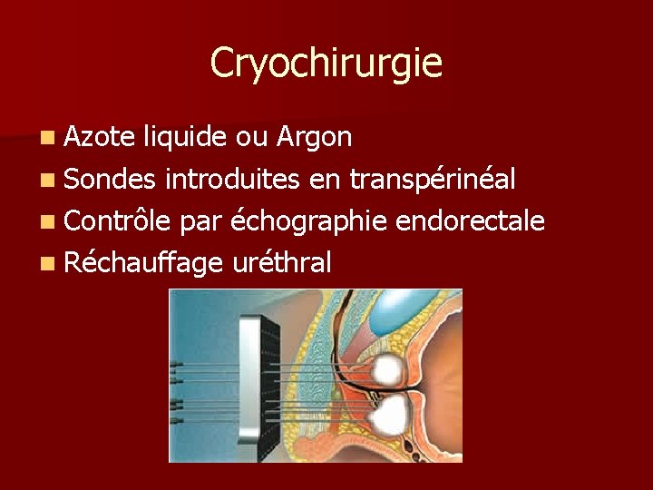Cryochirurgie n Azote liquide ou Argon n Sondes introduites en transpérinéal n Contrôle par
