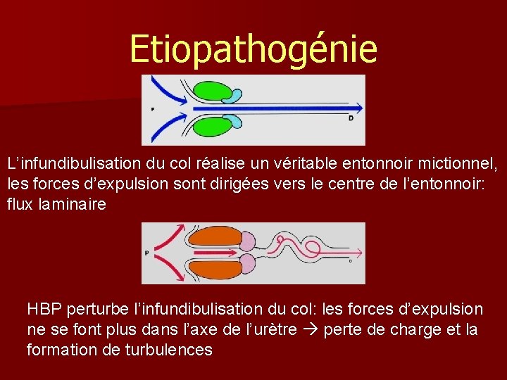 Etiopathogénie L’infundibulisation du col réalise un véritable entonnoir mictionnel, les forces d’expulsion sont dirigées