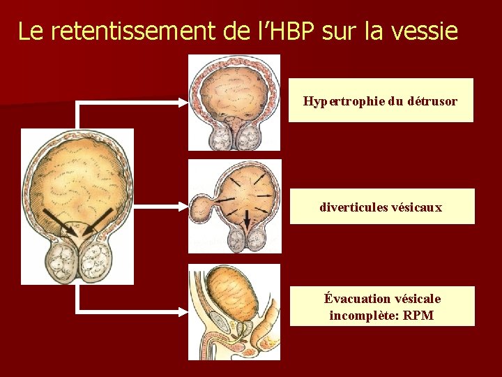 Le retentissement de l’HBP sur la vessie Hypertrophie du détrusor diverticules vésicaux Évacuation vésicale