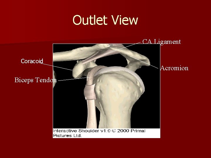 Outlet View CA Ligament Coracoid Biceps Tendon Acromion 