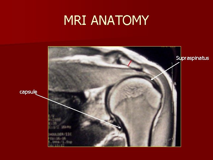 MRI ANATOMY Supraspinatus capsule 