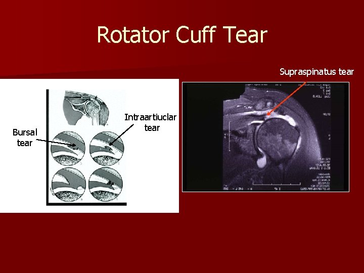 Rotator Cuff Tear Supraspinatus tear Bursal tear Intraartiuclar tear 
