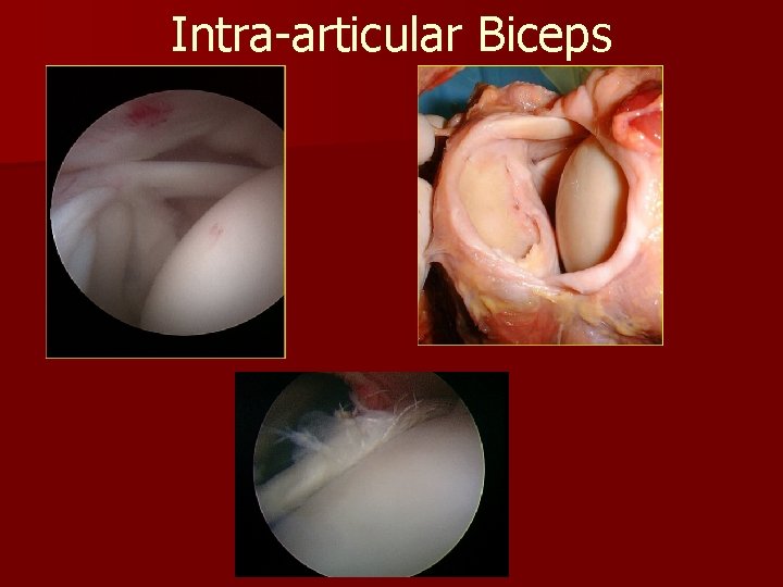 Intra-articular Biceps 