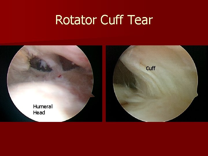 Rotator Cuff Tear Cuff Humeral Head 