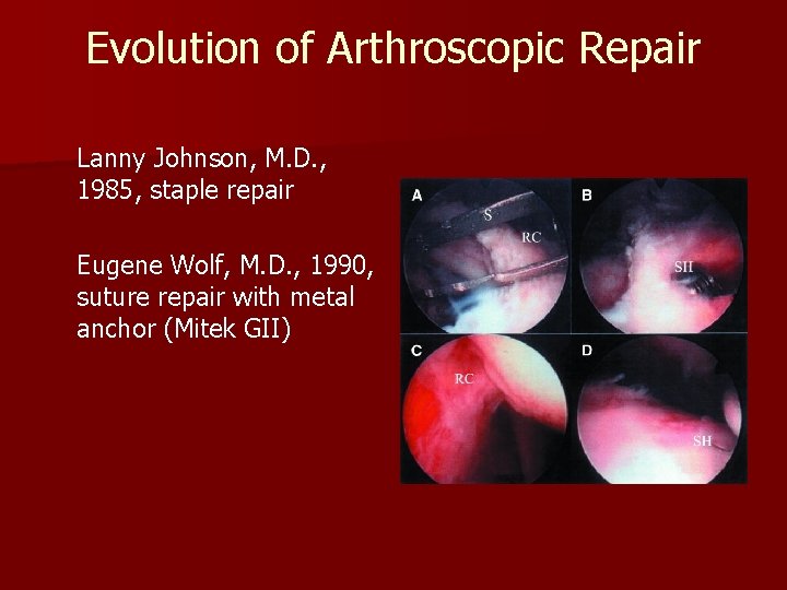 Evolution of Arthroscopic Repair Lanny Johnson, M. D. , 1985, staple repair Eugene Wolf,