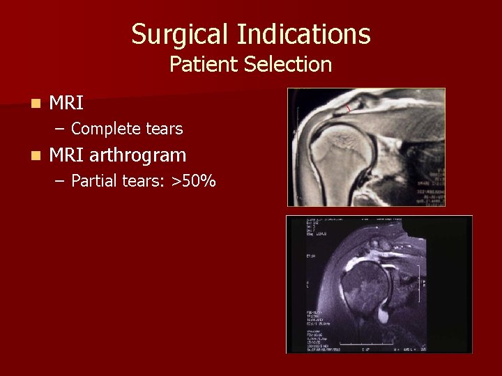 Surgical Indications Patient Selection n MRI – Complete tears n MRI arthrogram – Partial