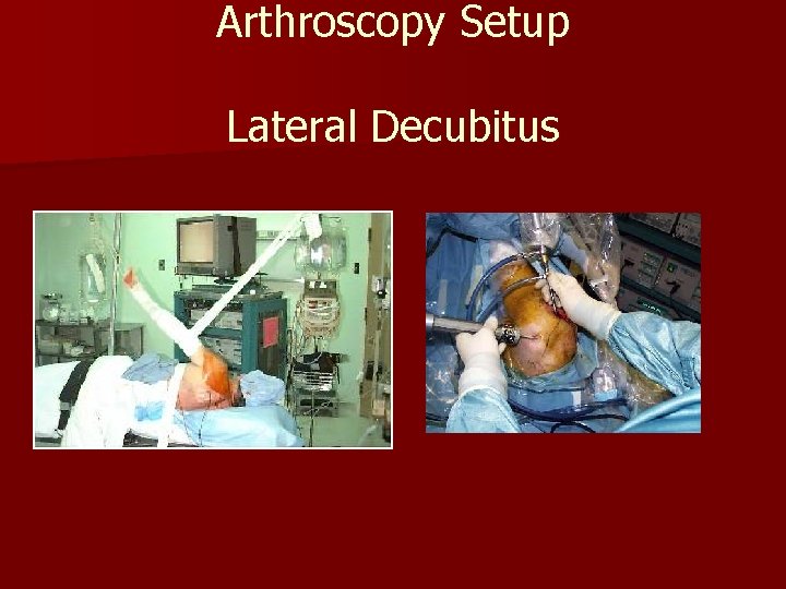 Arthroscopy Setup Lateral Decubitus 