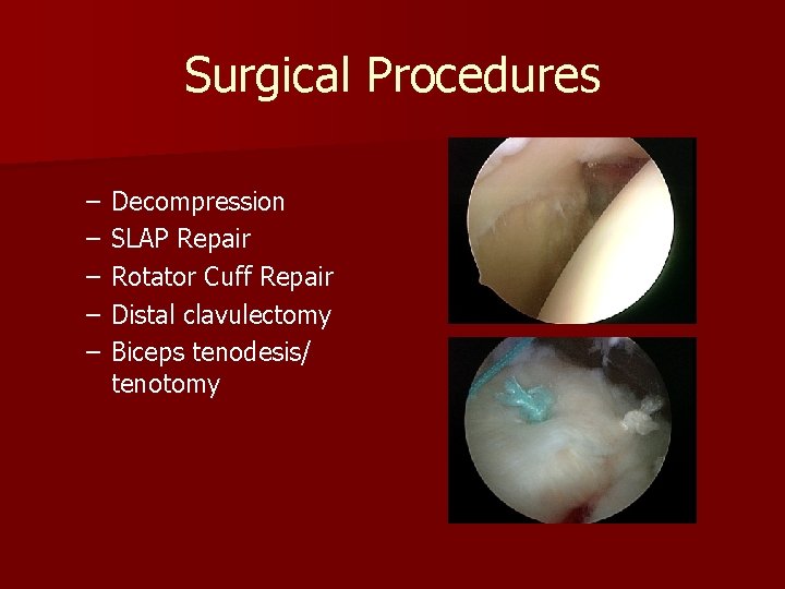 Surgical Procedures – – – Decompression SLAP Repair Rotator Cuff Repair Distal clavulectomy Biceps