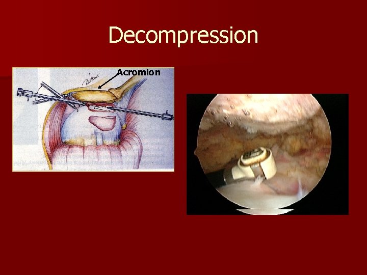 Decompression Acromion 