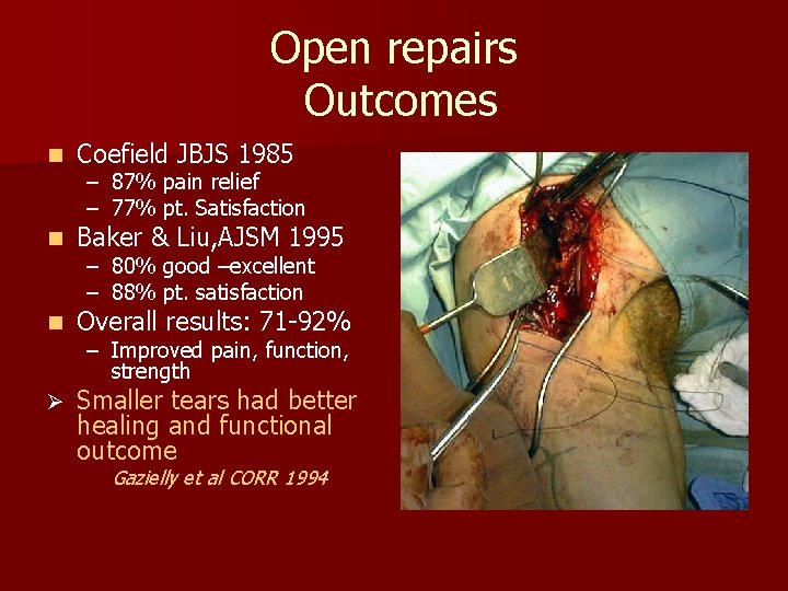 Open repairs Outcomes n Coefield JBJS 1985 n Baker & Liu, AJSM 1995 n