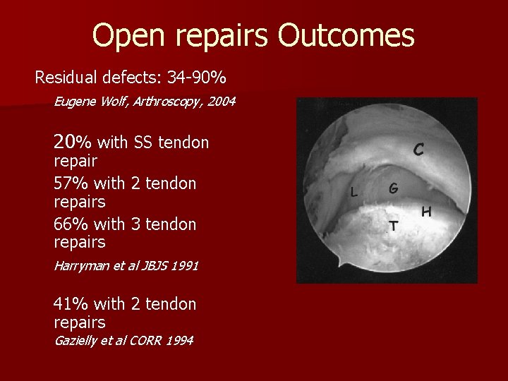 Open repairs Outcomes Residual defects: 34 -90% Eugene Wolf, Arthroscopy, 2004 20% with SS