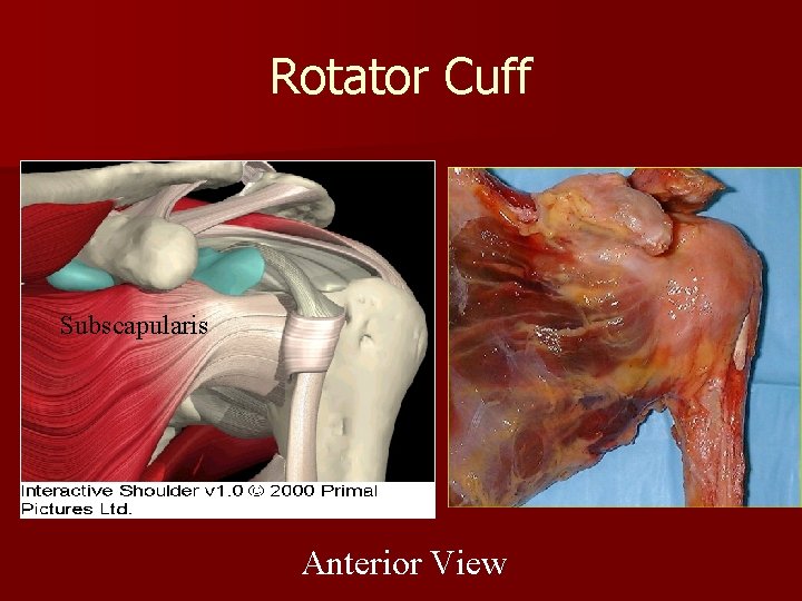 Rotator Cuff Subscapularis Anterior View 