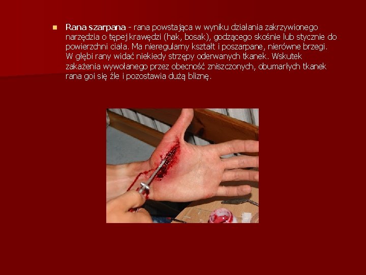 n Rana szarpana - rana powstająca w wyniku działania zakrzywionego narzędzia o tępej krawędzi