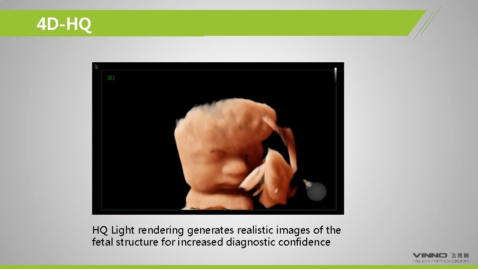 4 D-HQ HQ Light rendering generates realistic images of the fetal structure for increased