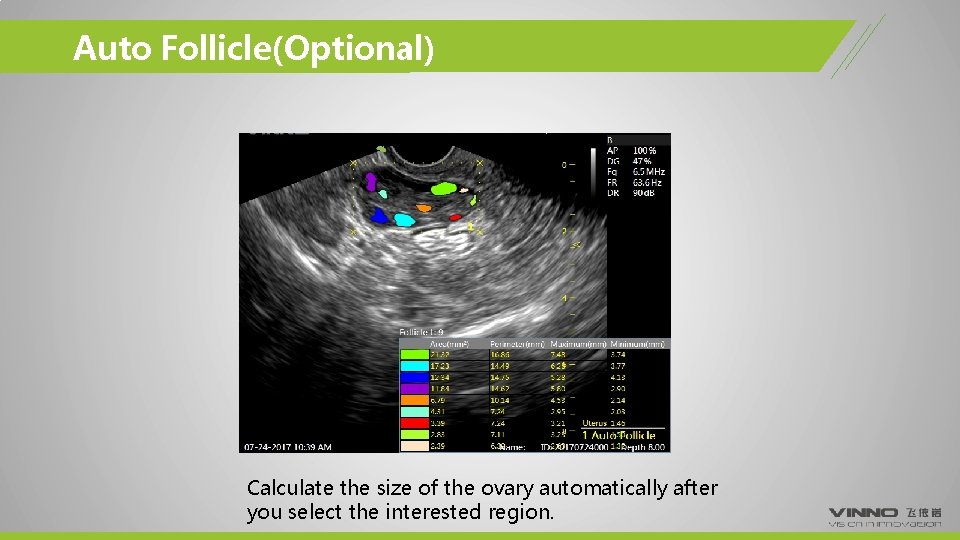 Auto Follicle(Optional) Calculate the size of the ovary automatically after you select the interested