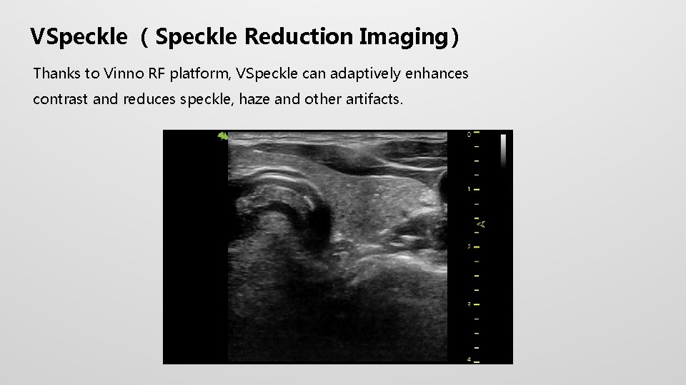 VSpeckle （Speckle Reduction Imaging） Thanks to Vinno RF platform, VSpeckle can adaptively enhances contrast