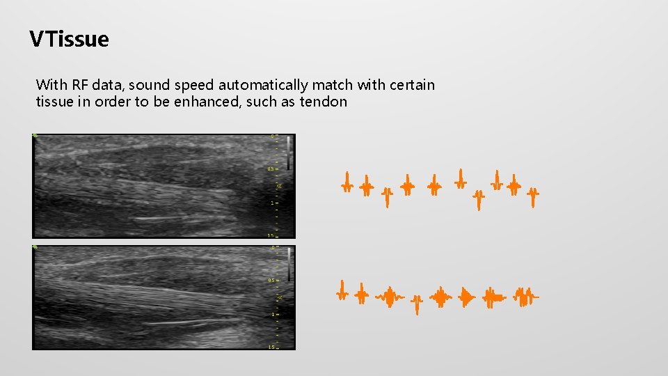 VTissue With RF data, sound speed automatically match with certain tissue in order to