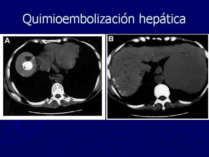 Quimioembolización hepática 