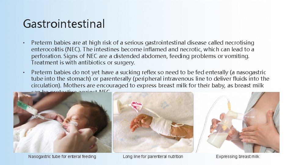 Gastrointestinal • Preterm babies are at high risk of a serious gastrointestinal disease called