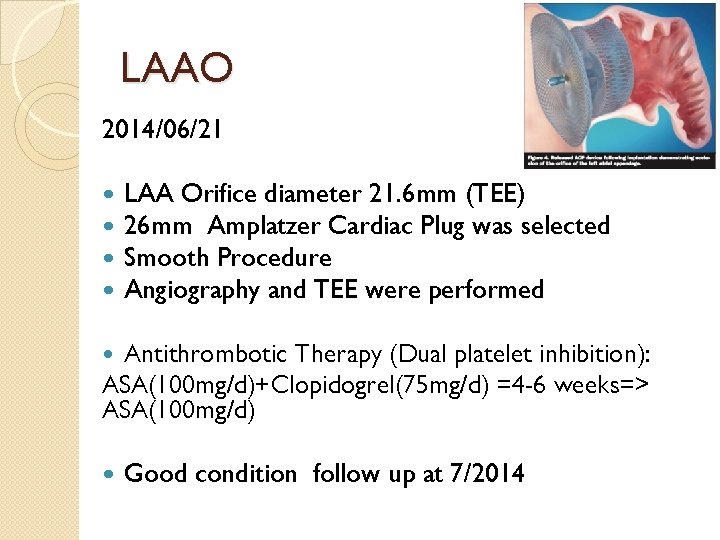 LAAO 2014/06/21 LAA Orifice diameter 21. 6 mm (TEE) 26 mm Amplatzer Cardiac Plug