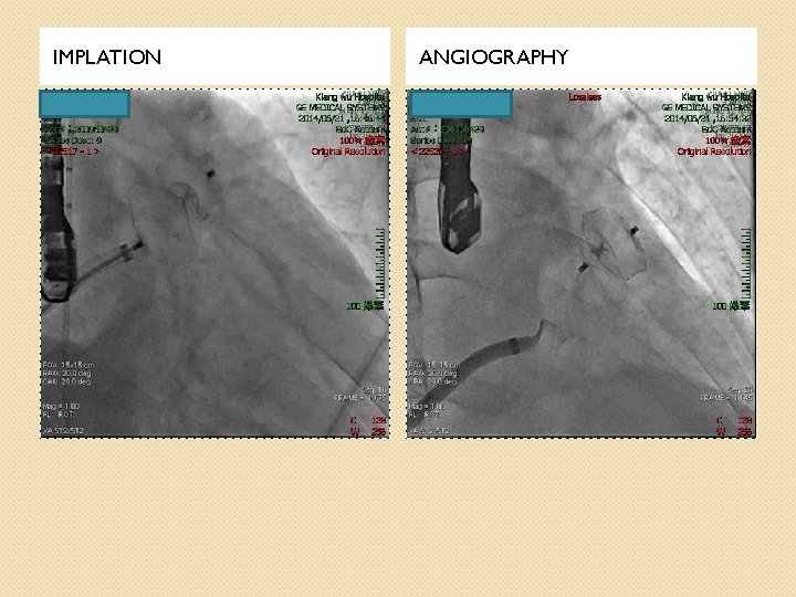 IMPLATION ANGIOGRAPHY 