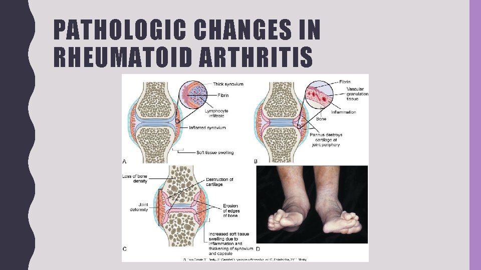 PATHOLOGIC CHANGES IN RHEUMATOID ARTHRITIS 