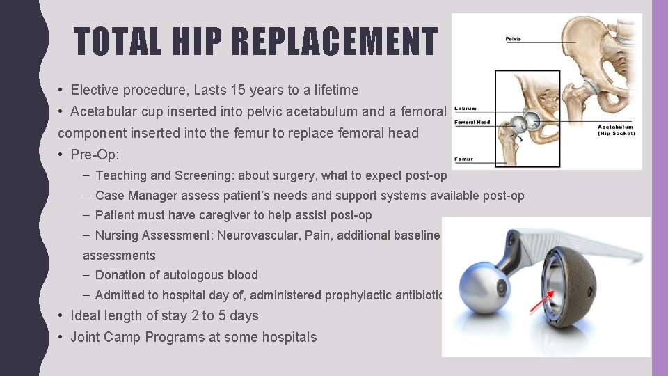 TOTAL HIP REPLACEMENT • Elective procedure, Lasts 15 years to a lifetime • Acetabular