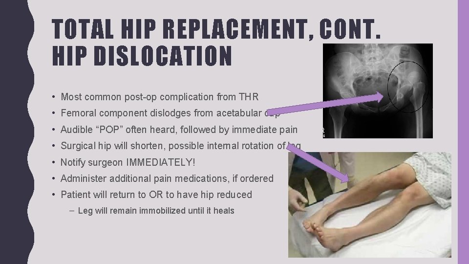 TOTAL HIP REPLACEMENT, CONT. HIP DISLOCATION • Most common post-op complication from THR •