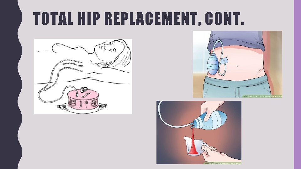 TOTAL HIP REPLACEMENT, CONT. 