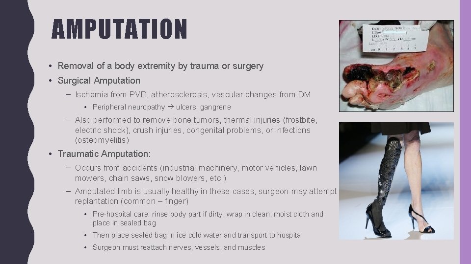 AMPUTATION • Removal of a body extremity by trauma or surgery • Surgical Amputation