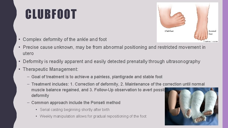 CLUBFOOT • Complex deformity of the ankle and foot • Precise cause unknown, may