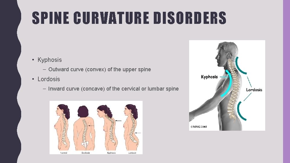 SPINE CURVATURE DISORDERS • Kyphosis – Outward curve (convex) of the upper spine •