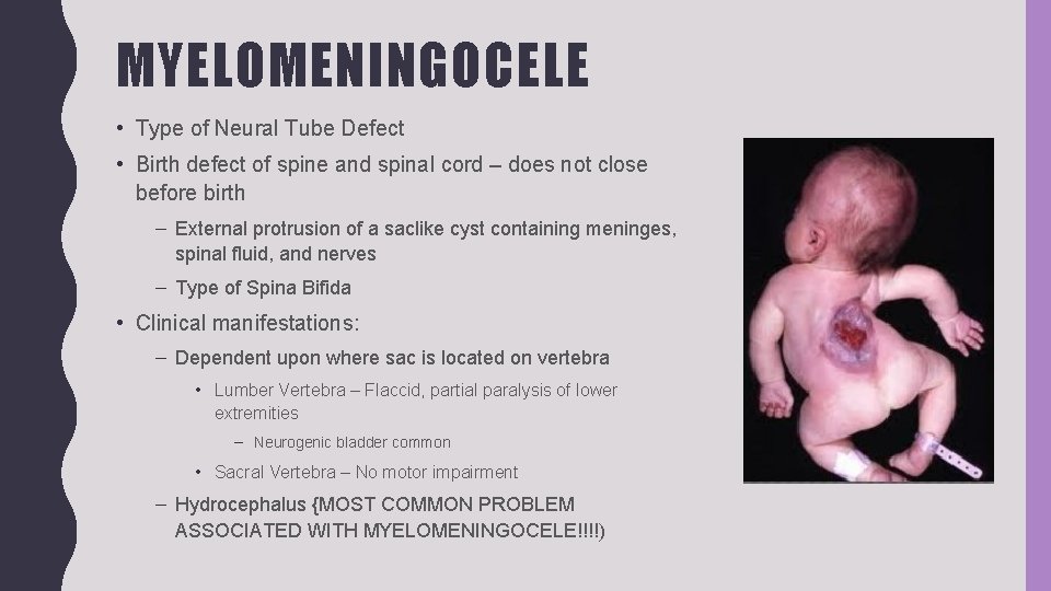 MYELOMENINGOCELE • Type of Neural Tube Defect • Birth defect of spine and spinal