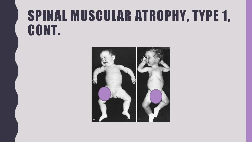 SPINAL MUSCULAR ATROPHY, TYPE 1, CONT. 