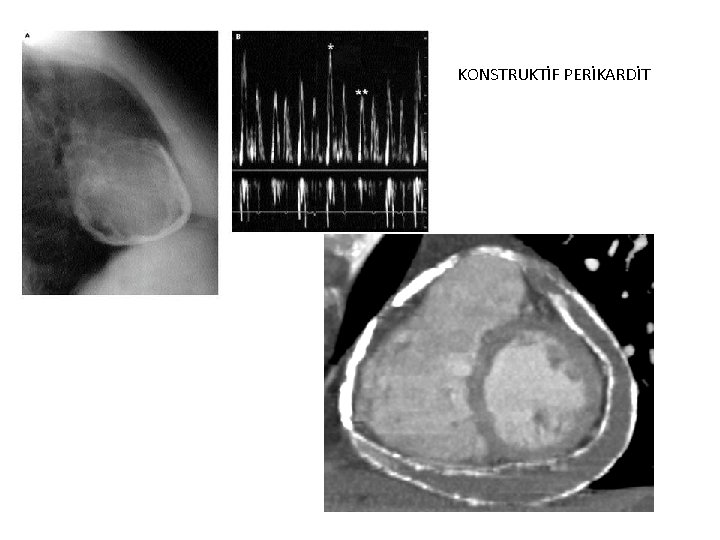 KONSTRUKTİF PERİKARDİT 
