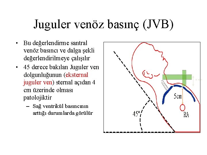 Juguler venöz basınç (JVB) • Bu değerlendirme santral venöz basıncı ve dalga şekli değerlendirilmeye