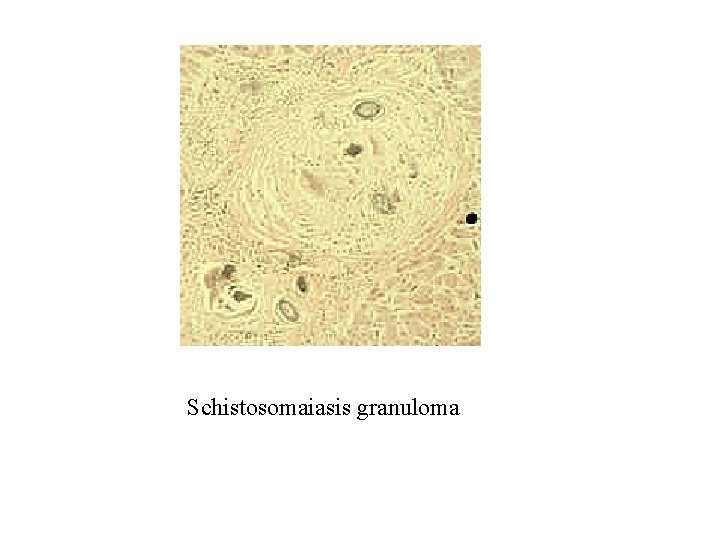 Schistosomaiasis granuloma Schistosomaiasis granuloma