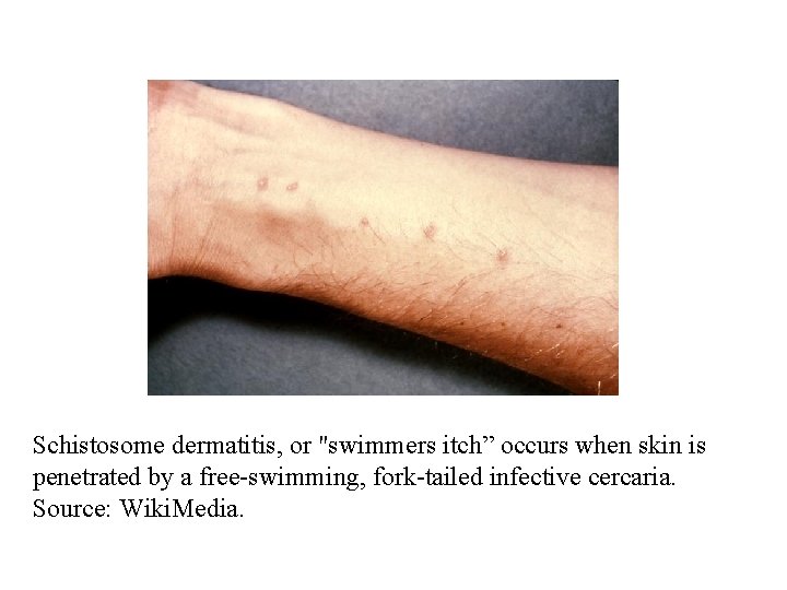 Schistosome dermatitis, or "swimmers itch” occurs when skin is penetrated by a free-swimming, fork-tailed Schistosome dermatitis, or "swimmers itch” occurs when skin is penetrated by a free-swimming, fork-tailed