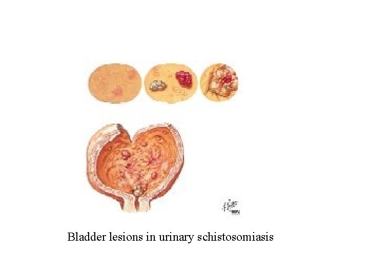 Bladder lesions in urinary schistosomiasis Bladder lesions in urinary schistosomiasis