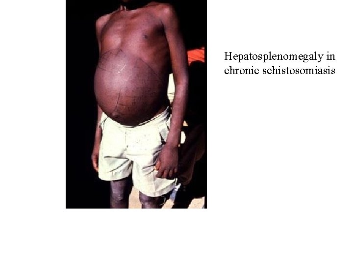 Hepatosplenomegaly in chronic schistosomiasis Hepatosplenomegaly in chronic schistosomiasis